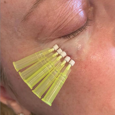 25mm Pdo Pclの下の目の容積の損失のための吸収性の糸の上昇Wのタイプ鈍いCannula